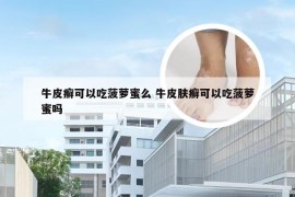 牛皮癣可以吃菠萝蜜么 牛皮肤癣可以吃菠萝蜜吗