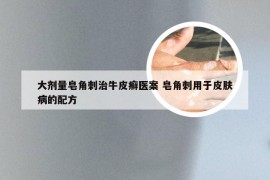 大剂量皂角刺治牛皮癣医案 皂角刺用于皮肤病的配方