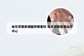 哈尔滨银屑病医院哪里好 哈尔滨银屑病治疗中心