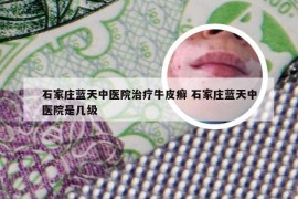 石家庄蓝天中医院治疗牛皮癣 石家庄蓝天中医院是几级