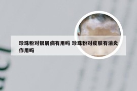 珍珠粉对银屑病有用吗 珍珠粉对皮肤有消炎作用吗