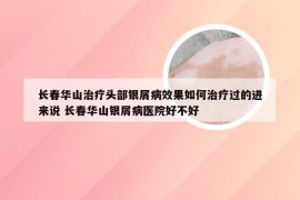 长春华山治疗头部银屑病效果如何治疗过的进来说 长春华山银屑病医院好不好