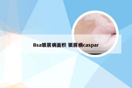 Bsa银屑病面积 银屑病caspar