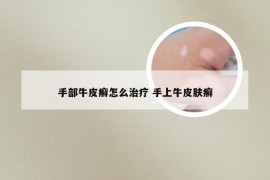 手部牛皮癣怎么治疗 手上牛皮肤癣