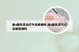 维a酸乳膏治疗牛皮癣病吗 维a酸乳膏可以治银屑病吗