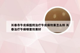 长春市牛皮癣医院治疗牛皮癣效果怎么样 长春治疗牛癣哪里效果好