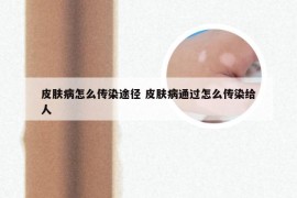 皮肤病怎么传染途径 皮肤病通过怎么传染给人