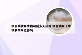 银屑病使用生物制剂多久反弹 银屑病用了生物制剂不能停吗