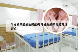 牛皮癣早起能治彻底吗 牛皮肤癣早发现可以好吗