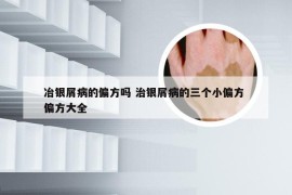 冶银屑病的偏方吗 治银屑病的三个小偏方 偏方大全