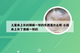 儿童身上长的跟癣一样的东西是什么呢 小孩身上长了像癣一样的