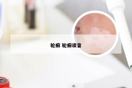 轮癣 轮癣读音