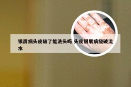 银屑病头皮破了能洗头吗 头皮银屑病挠破流水