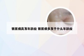 银屑病高发年龄段 银屑病多发于什么年龄段