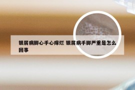 银屑病脚心手心痒烂 银屑病手脚严重是怎么回事