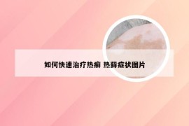 如何快速治疗热癣 热藓症状图片