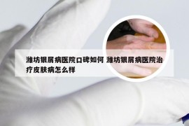 潍坊银屑病医院口碑如何 潍坊银屑病医院治疗皮肤病怎么样