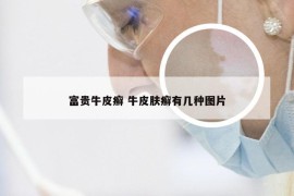 富贵牛皮癣 牛皮肤癣有几种图片