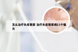 怎么治疗头皮银屑 治疗头皮银屑病13个偏方