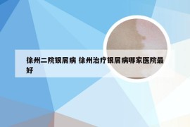 徐州二院银屑病 徐州治疗银屑病哪家医院最好