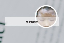 牛皮癣四疗