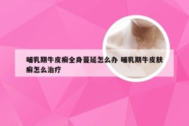 哺乳期牛皮癣全身蔓延怎么办 哺乳期牛皮肤癣怎么治疗
