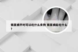 银屑病平时可以吃什么食物 银屑病能吃什么?