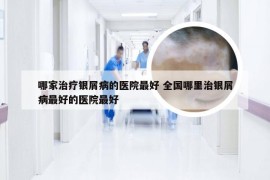 哪家治疗银屑病的医院最好 全国哪里治银屑病最好的医院最好