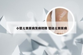 小婴儿银屑病发病初期 婴幼儿银屑病