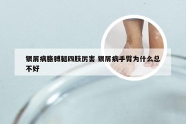 银屑病胳膊腿四肢厉害 银屑病手臂为什么总不好