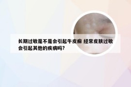 长期过敏是不是会引起牛皮癣 经常皮肤过敏会引起其他的疾病吗?