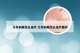 几年的癣怎么治疗 几年的癣怎么治疗最好