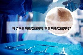 得了银屑病能吃韭黄吗 银屑病能吃韭黄吗?