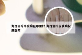 海口治疗牛皮癣在哪里好 海口治疗皮肤病权威医院