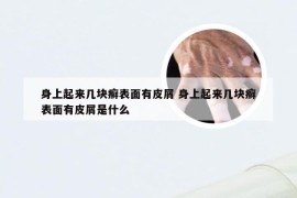 身上起来几块癣表面有皮屑 身上起来几块癣表面有皮屑是什么