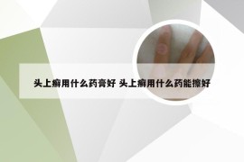 头上癣用什么药膏好 头上癣用什么药能擦好