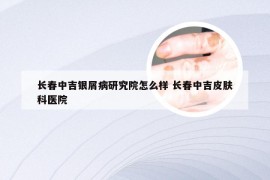 长春中吉银屑病研究院怎么样 长春中吉皮肤科医院