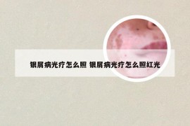银屑病光疗怎么照 银屑病光疗怎么照红光