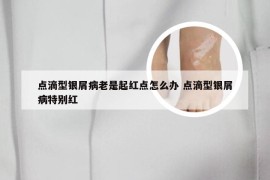 点滴型银屑病老是起红点怎么办 点滴型银屑病特别红