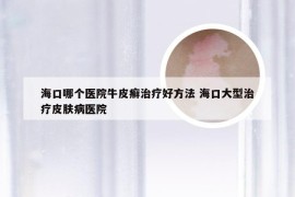 海口哪个医院牛皮癣治疗好方法 海口大型治疗皮肤病医院