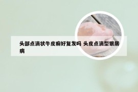 头部点滴状牛皮癣好复发吗 头皮点滴型银屑病