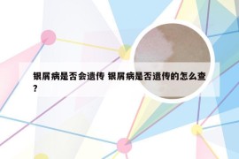 银屑病是否会遗传 银屑病是否遗传的怎么查?