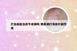 打治血能治皮牛皮癣吗 银屑病打清血针副作用