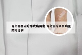 青岛哪里治疗牛皮癣厉害 青岛治疗银屑病医院排行榜