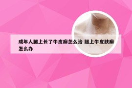 成年人腿上长了牛皮癣怎么治 腿上牛皮肤癣怎么办