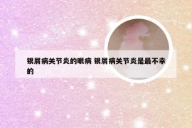 银屑病关节炎的眼病 银屑病关节炎是最不幸的