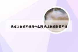 头皮上有癣不痒用什么药 头上长癣但是不痒