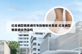 红皮病型银屑病可导致哪些并发症 红皮病型银屑病会传染吗