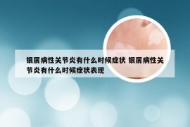 银屑病性关节炎有什么时候症状 银屑病性关节炎有什么时候症状表现