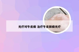 光疗对牛皮癣 治疗牛皮肤癣光疗